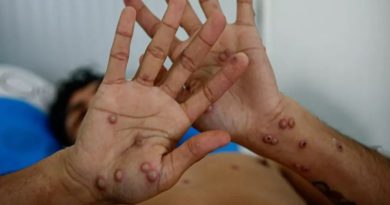 OMS anuncia emergencia mundial por viruela del mono