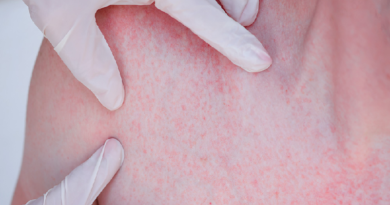 ¿Qué es la dermatitis y cómo afecta la salud mental?