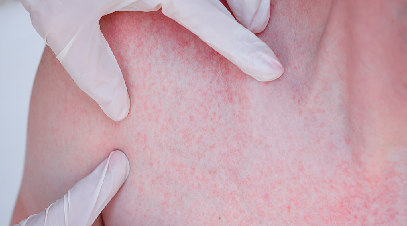 ¿Qué es la dermatitis y cómo afecta la salud mental?