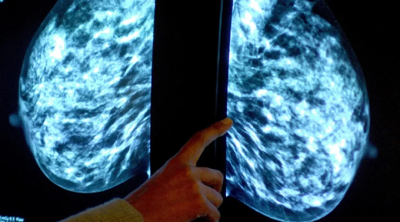 Beneficios de la radioterapia contra el cáncer de mama duran una década