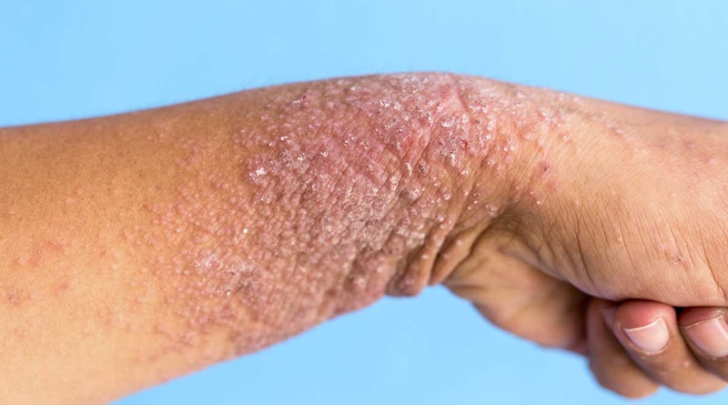 Día Mundial de la Dermatitis Atópica: señales y síntomas que no se deben ignorar