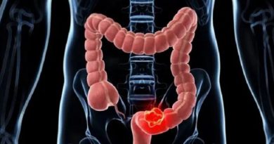 Aumenta cáncer intestinal en jóvenes a nivel global