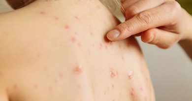 Nueva variante de mpox es calificada de "alto riesgo" según la OMS