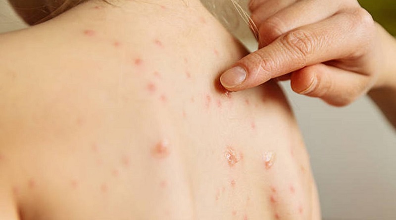 Nueva variante de mpox es calificada de "alto riesgo" según la OMS