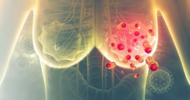 Presentan avances en nueva terapia contra el cáncer de mama en fases tempranas