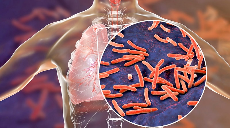 Científicos argentinos desarrollan test contra la tuberculosis