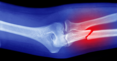 Células capaces de “convertirse en hueso” podrían ser clave para curar fracturas